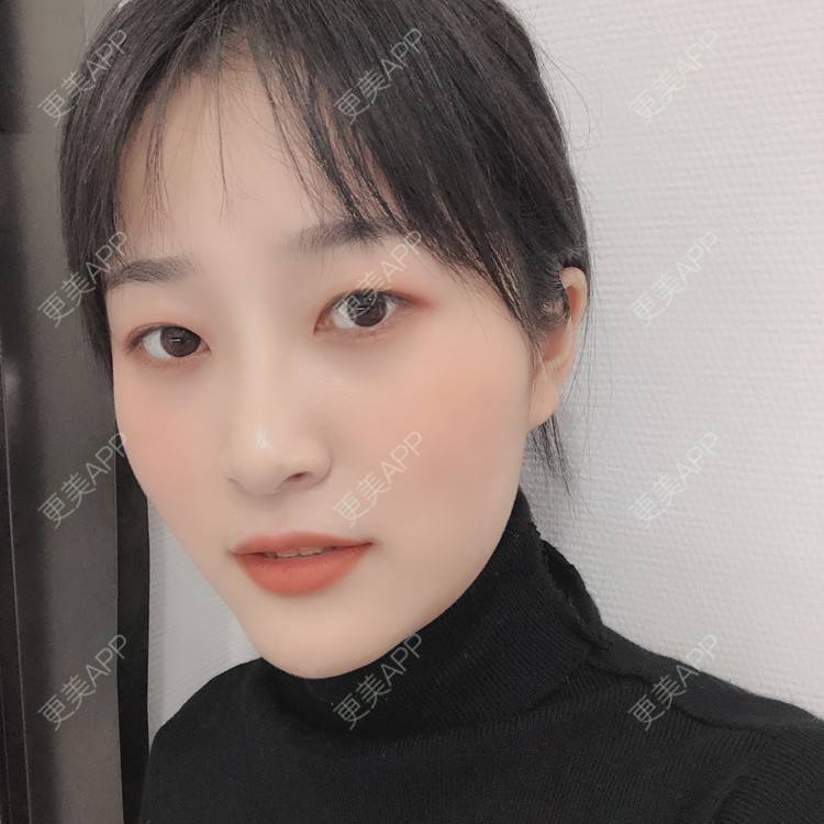 更美 - 欣欣的后花园的激光淡斑经验 | 皮秒激光 | 激光淡斑 | 武汉