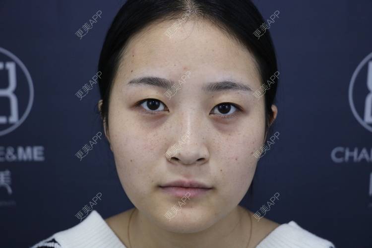 更美 - 欣欣的后花园的激光淡斑经验 | 皮秒激光 | 激光淡斑 | 武汉