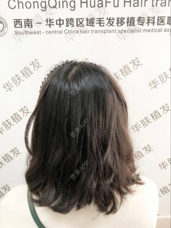 更美 - 更美用户PkjDqlmGSW的植胡须经验 | 植发际线 | 植眉 | 鬓角植发 | 植胡须 | 重庆 | 毛发移植