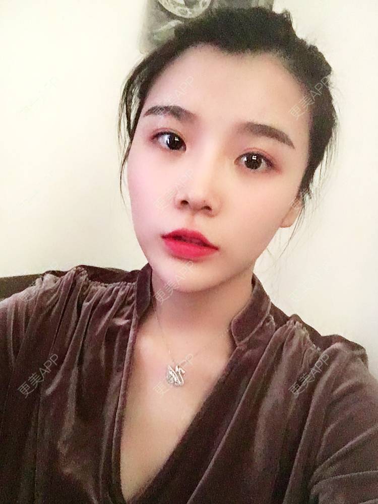 更美 - 留海君的玻尿酸眉弓经验 | 玻尿酸太阳穴 | 玻尿酸泪沟 | 玻尿酸眉弓 | 广州