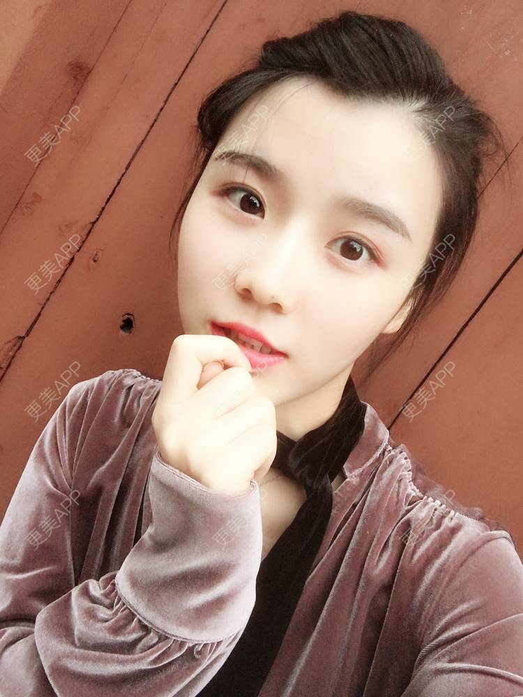 更美 - 留海君的玻尿酸眉弓经验 | 玻尿酸太阳穴 | 玻尿酸泪沟 | 玻尿酸眉弓 | 广州