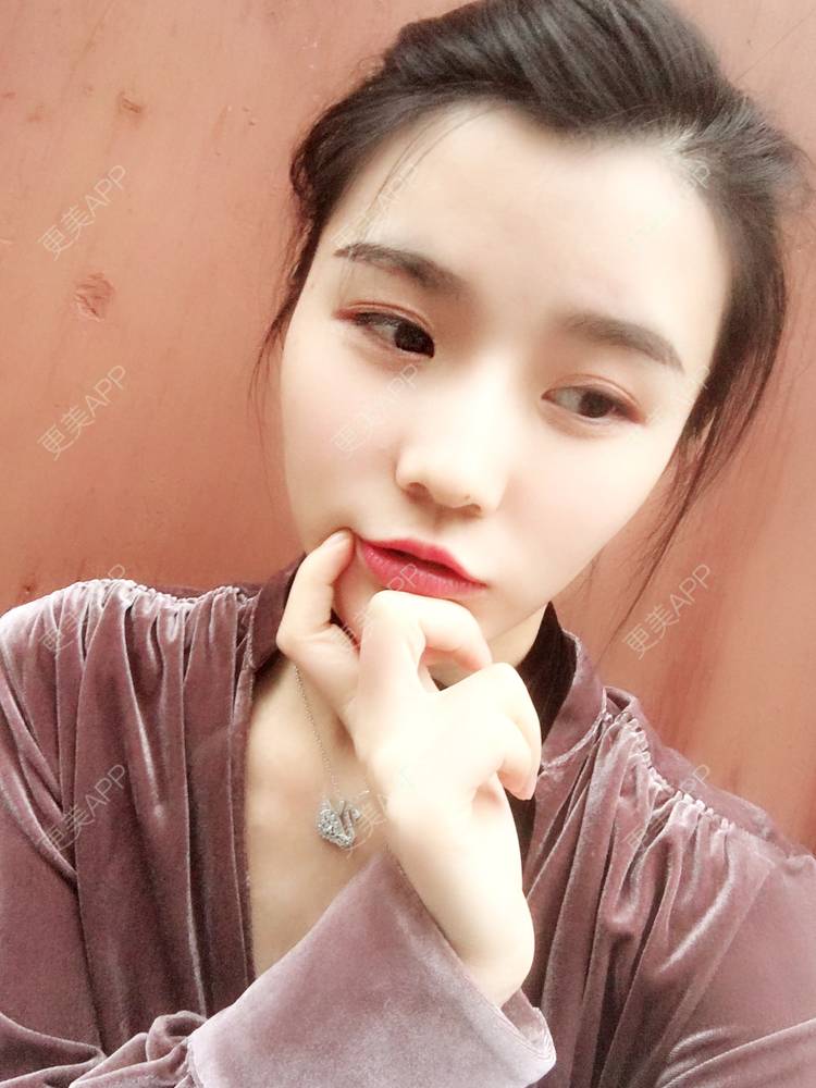 更美 - 留海君的玻尿酸眉弓经验 | 玻尿酸太阳穴 | 玻尿酸泪沟 | 玻尿酸眉弓 | 广州