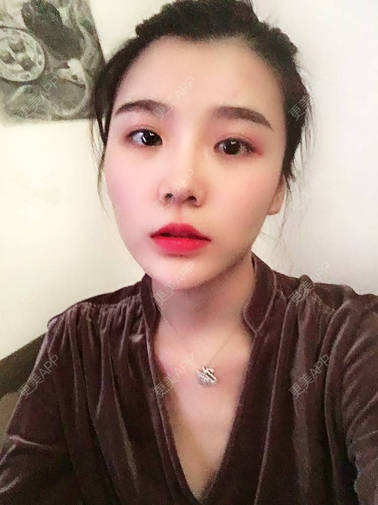 更美 - 留海君的玻尿酸眉弓经验 | 玻尿酸太阳穴 | 玻尿酸泪沟 | 玻尿酸眉弓 | 广州