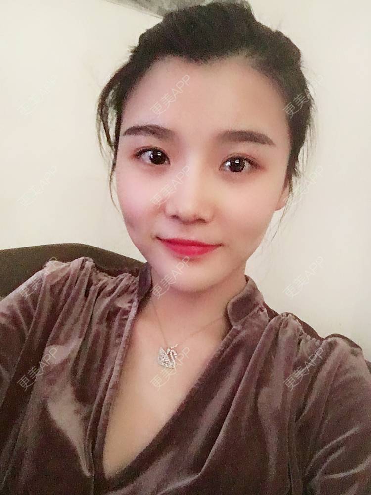 更美 - 留海君的玻尿酸眉弓经验 | 玻尿酸太阳穴 | 玻尿酸泪沟 | 玻尿酸眉弓 | 广州