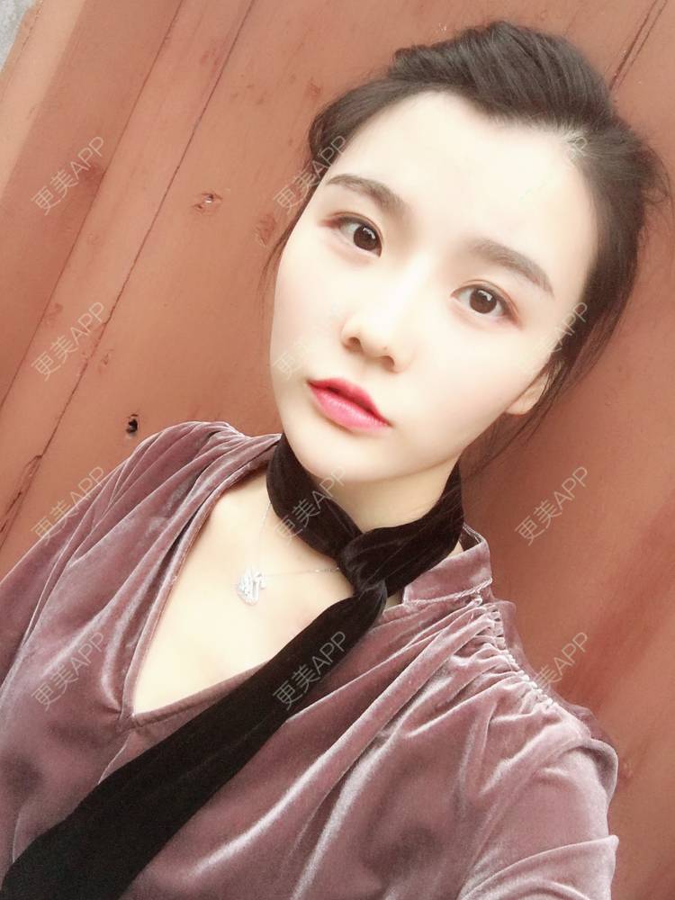 更美 - 留海君的玻尿酸眉弓经验 | 玻尿酸太阳穴 | 玻尿酸泪沟 | 玻尿酸眉弓 | 广州