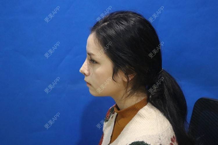 更美 - 温情火光的肋软骨隆鼻经验 | 肋软骨隆鼻 | 鼻翼缩小 | 鼻部多项 | 武汉