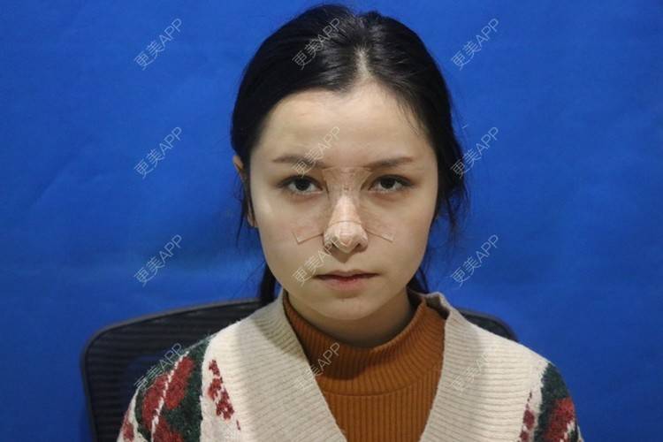 更美 - 温情火光的肋软骨隆鼻经验 | 肋软骨隆鼻 | 鼻翼缩小 | 鼻部多项 | 武汉