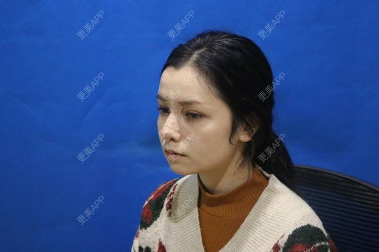更美 - 温情火光的肋软骨隆鼻经验 | 肋软骨隆鼻 | 鼻翼缩小 | 鼻部多项 | 武汉