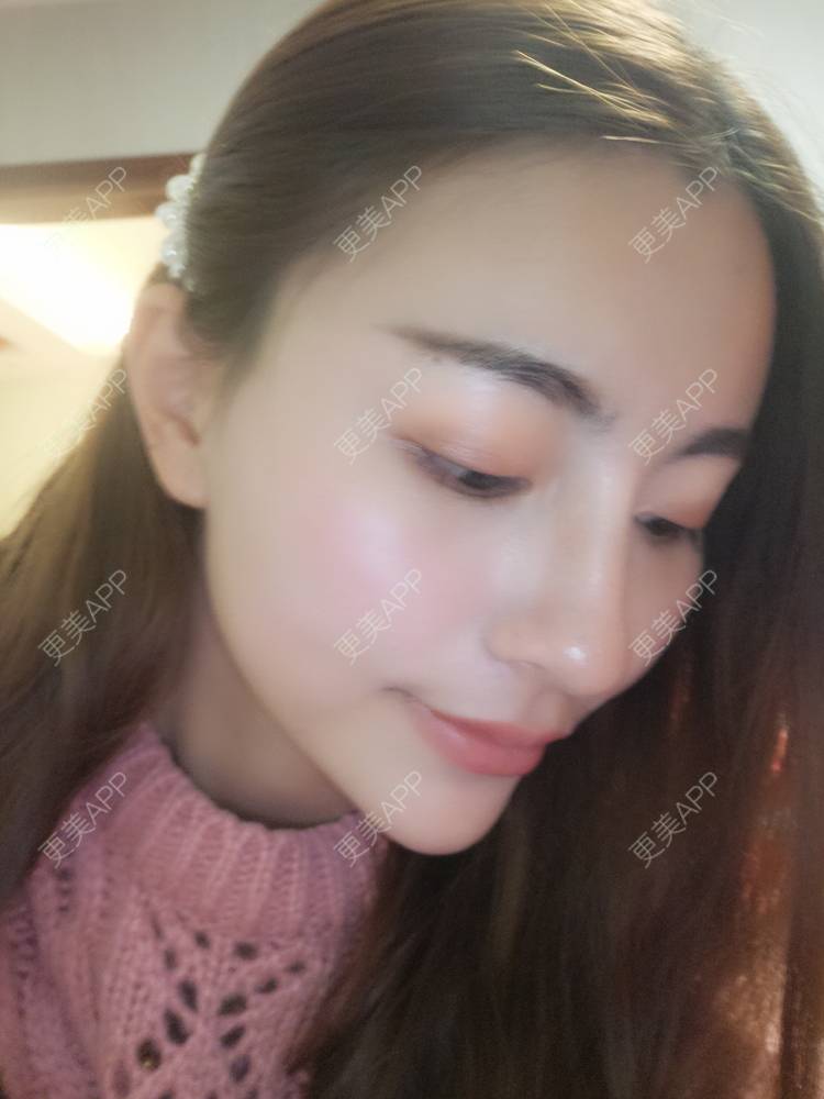 更美 - YOYO球的镭射净肤经验 | 镭射净肤 | 广州