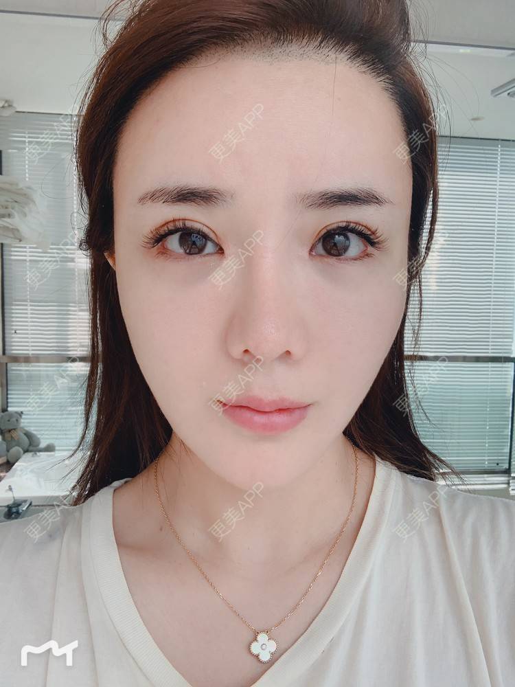 更美 - 更美用户172eQJTacC的开眼角修复经验 | 视频日记 | 开眼角修复