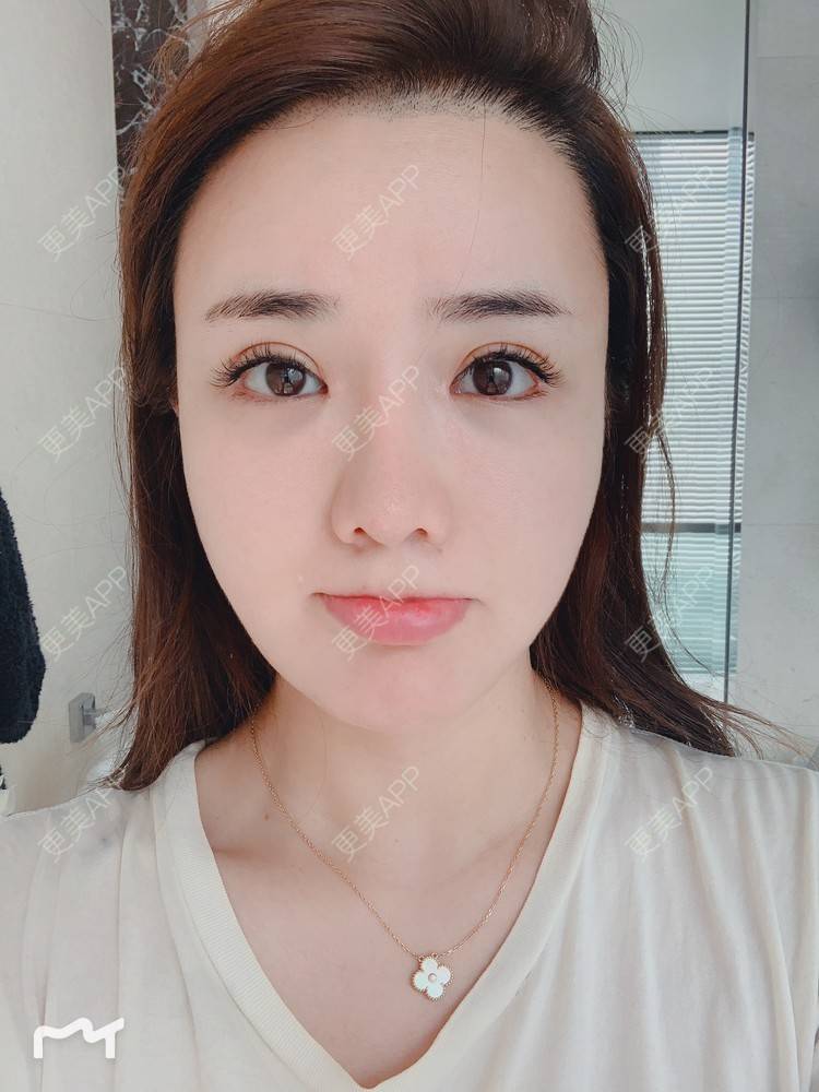 更美 - 更美用户172eQJTacC的开眼角修复经验 | 视频日记 | 开眼角修复