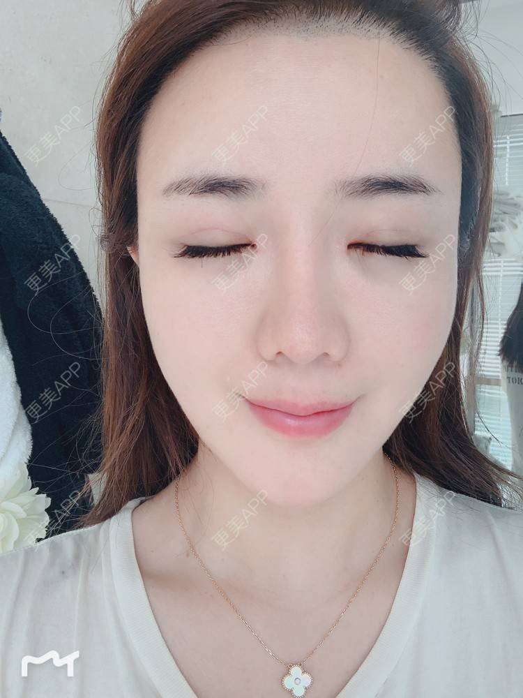 更美 - 更美用户172eQJTacC的开眼角修复经验 | 视频日记 | 开眼角修复