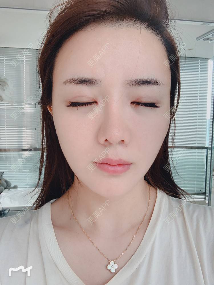 更美 - 更美用户172eQJTacC的开眼角修复经验 | 视频日记 | 开眼角修复