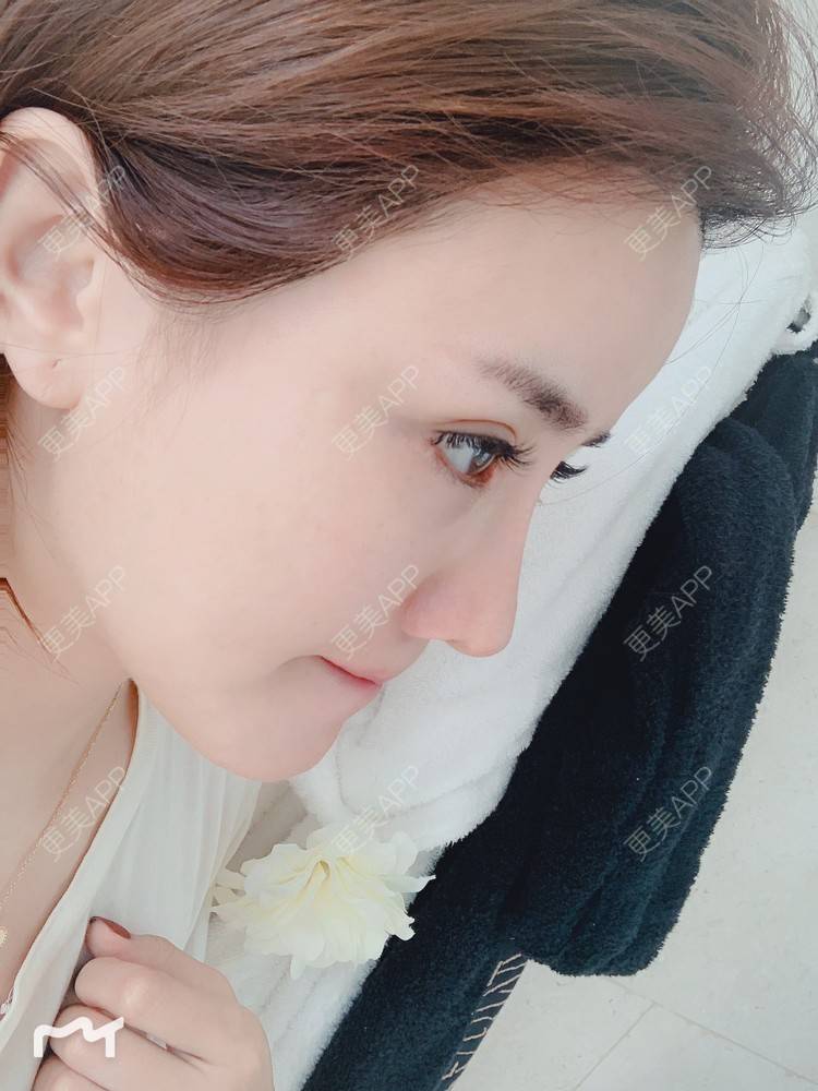 更美 - 更美用户172eQJTacC的开眼角修复经验 | 视频日记 | 开眼角修复