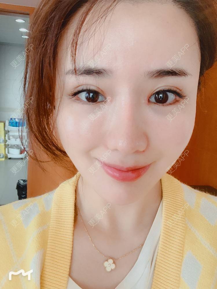 更美 - 更美用户172eQJTacC的开眼角修复经验 | 视频日记 | 开眼角修复