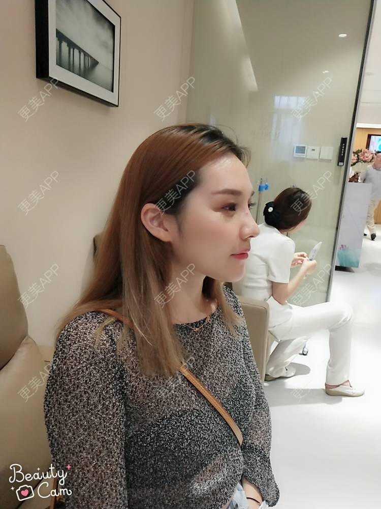 更美 - 更美用户QgvqVyY1q0的硅胶隆鼻经验 | 硅胶隆鼻 | 肋软骨隆鼻 | 杭州