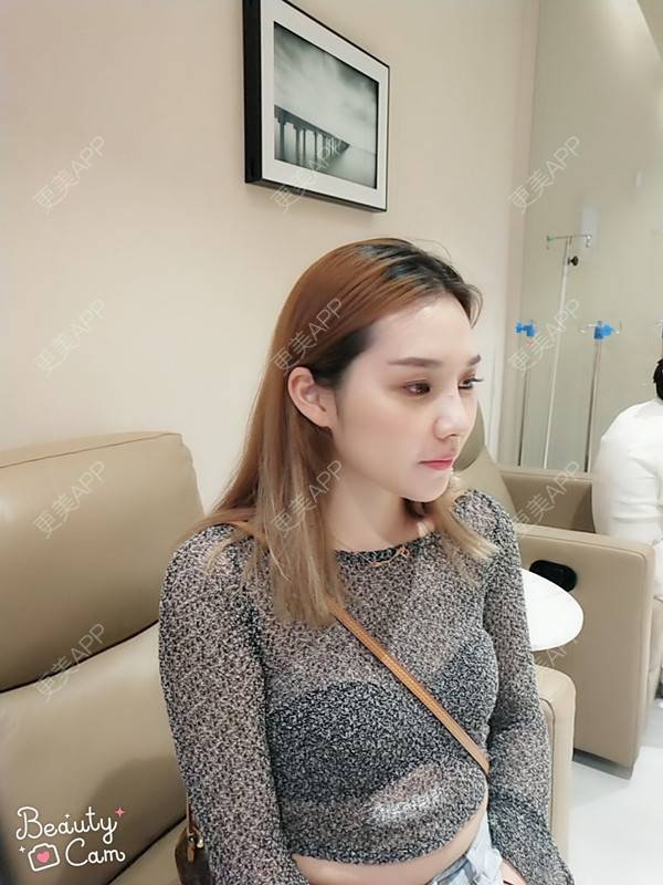 更美 - 更美用户QgvqVyY1q0的硅胶隆鼻经验 | 硅胶隆鼻 | 肋软骨隆鼻 | 杭州