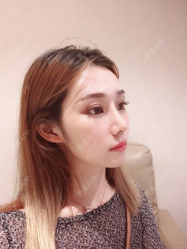 更美 - 更美用户QgvqVyY1q0的硅胶隆鼻经验 | 硅胶隆鼻 | 肋软骨隆鼻 | 杭州