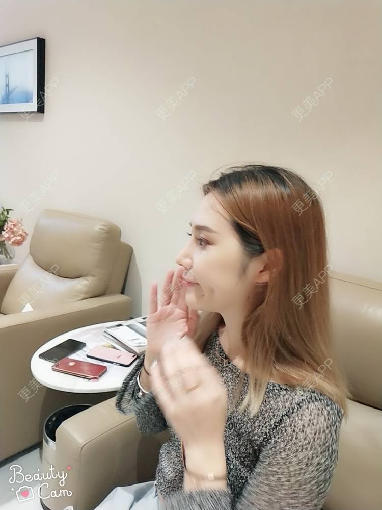 更美 - 更美用户QgvqVyY1q0的硅胶隆鼻经验 | 硅胶隆鼻 | 肋软骨隆鼻 | 杭州
