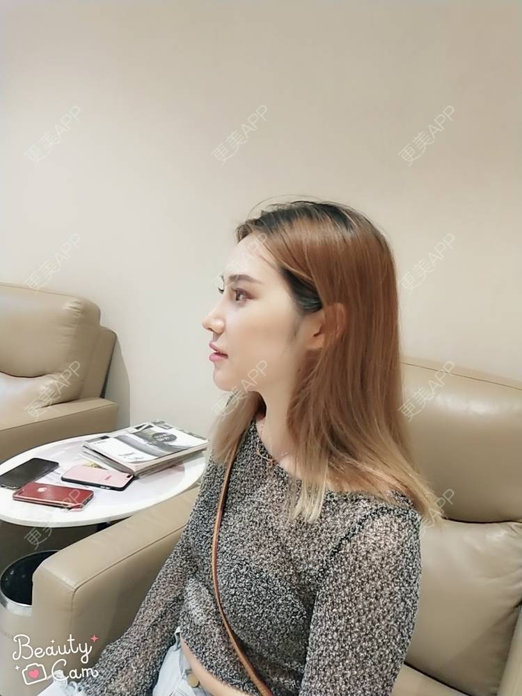 更美 - 更美用户QgvqVyY1q0的硅胶隆鼻经验 | 硅胶隆鼻 | 肋软骨隆鼻 | 杭州