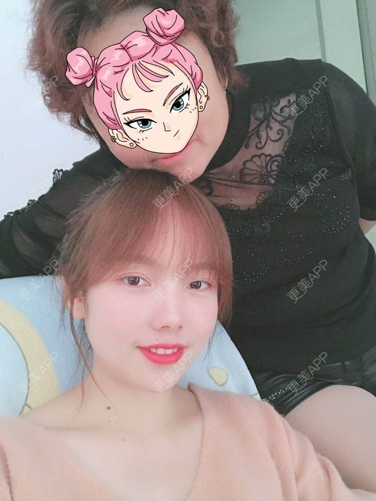 更美 - Amnot的自体脂肪丰面颊经验 | 自体脂肪丰面颊 | 自体脂肪丰太阳穴 | 重庆