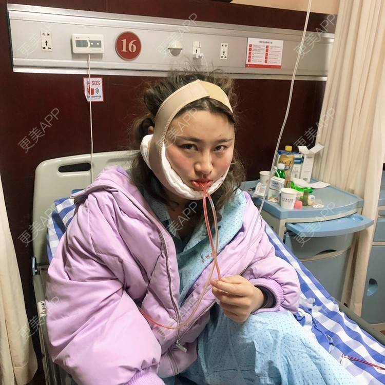 更美 - 泡沫ll的宽下巴矫正经验 | 宽下巴矫正 | 轮廓修复术 | 杭州
