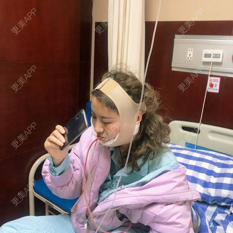更美 - 泡沫ll的宽下巴矫正经验 | 宽下巴矫正 | 轮廓修复术 | 杭州