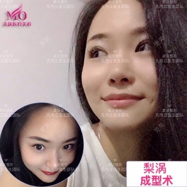 梨涡浅笑百媚生 梨涡·酒窝成形术_更美整形