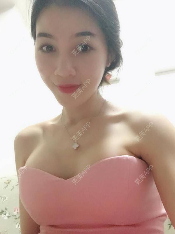假体隆胸效果图_术后387天__更美