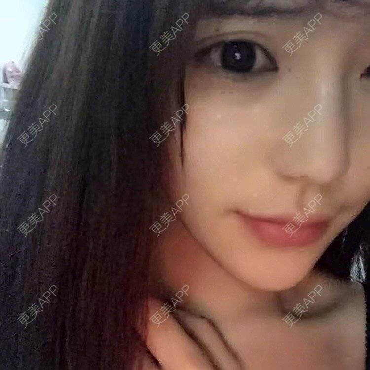 更美 - 我是小公主呀的埋线双眼皮经验 | 埋线双眼皮 | 肋软骨隆鼻 | 上海