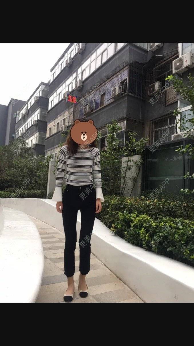 更美 - 文文美臀的自体脂肪丰臀经验 | 自体脂肪丰臀