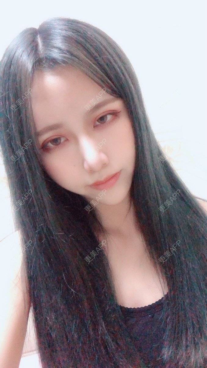 更美 - 可爱的猪猪呀的自体脂肪丰苹果肌经验 | 自体脂肪丰苹果肌 | 自体脂肪垫下巴 | 自体脂肪丰太阳穴 | 自体脂肪丰额头 | 杭州 | 自体脂肪全面部填充