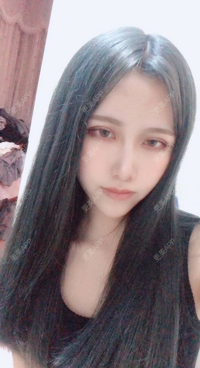 更美 - 可爱的猪猪呀的自体脂肪丰苹果肌经验 | 自体脂肪丰苹果肌 | 自体脂肪垫下巴 | 自体脂肪丰太阳穴 | 自体脂肪丰额头 | 杭州 | 自体脂肪全面部填充