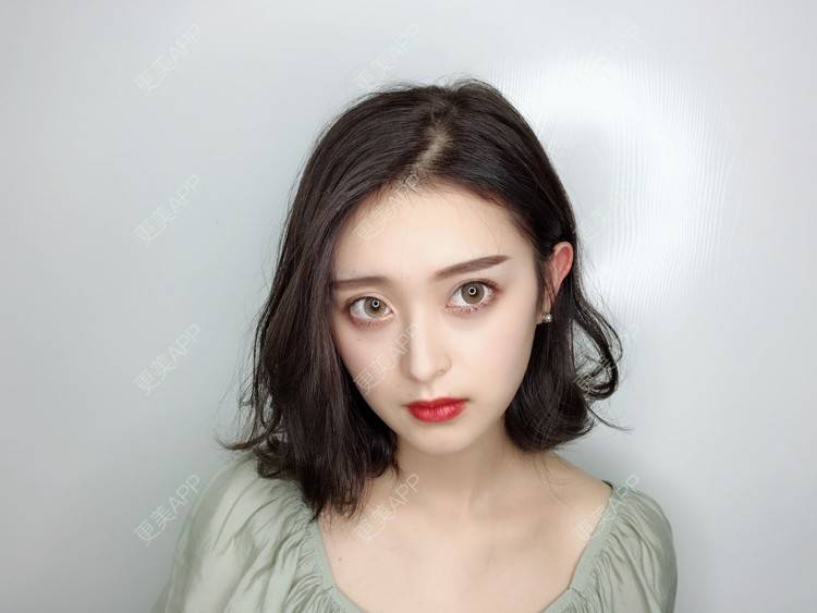 更美 - F姐姐的玻尿酸下巴经验 | 玻尿酸下巴 | 广州