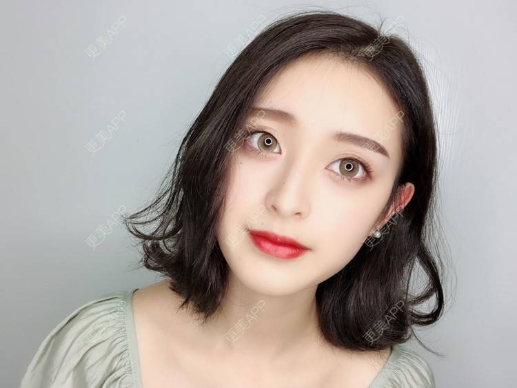 更美 - F姐姐的玻尿酸下巴经验 | 玻尿酸下巴 | 广州