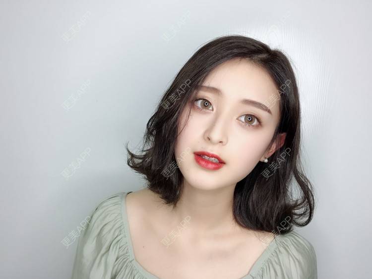 更美 - F姐姐的玻尿酸下巴经验 | 玻尿酸下巴 | 广州