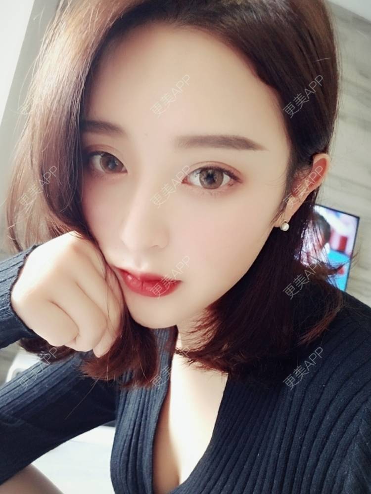 更美 - F姐姐的玻尿酸下巴经验 | 玻尿酸下巴 | 广州