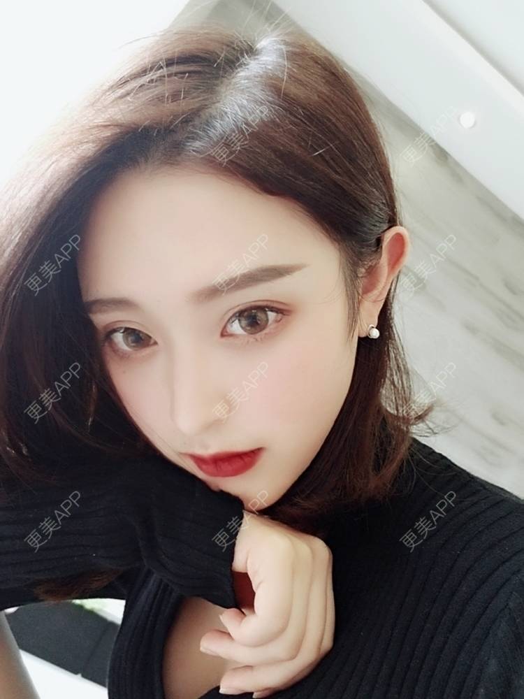 更美 - F姐姐的玻尿酸下巴经验 | 玻尿酸下巴 | 广州