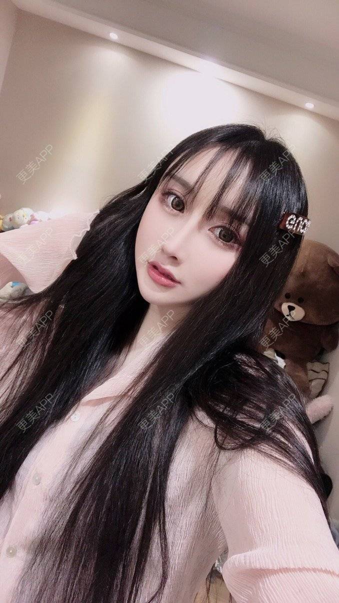 更美 - MeYou00的自体脂肪丰苹果肌经验 | 自体脂肪丰苹果肌 | 自体脂肪丰面颊 | 自体脂肪丰太阳穴 | 自体脂肪丰额头 | 杭州 | 自体脂肪全面部填充