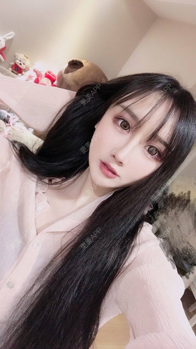 更美 - MeYou00的自体脂肪丰苹果肌经验 | 自体脂肪丰苹果肌 | 自体脂肪丰面颊 | 自体脂肪丰太阳穴 | 自体脂肪丰额头 | 杭州 | 自体脂肪全面部填充