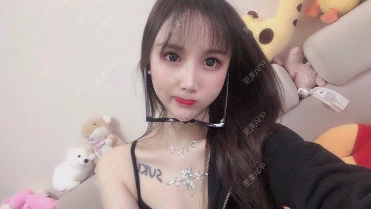 更美 - MeYou00的自体脂肪丰苹果肌经验 | 自体脂肪丰苹果肌 | 自体脂肪丰面颊 | 自体脂肪丰太阳穴 | 自体脂肪丰额头 | 杭州 | 自体脂肪全面部填充