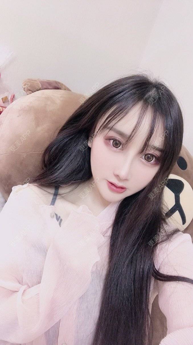 更美 - MeYou00的自体脂肪丰苹果肌经验 | 自体脂肪丰苹果肌 | 自体脂肪丰面颊 | 自体脂肪丰太阳穴 | 自体脂肪丰额头 | 杭州 | 自体脂肪全面部填充