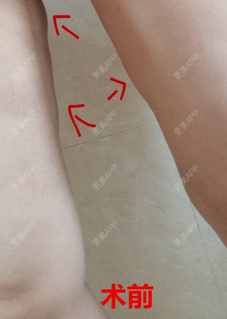 更美 - 更美用户28lcJSvOy1的自体脂肪隆胸经验 | 郑州 | 吸脂瘦大腿 | 自体脂肪隆胸