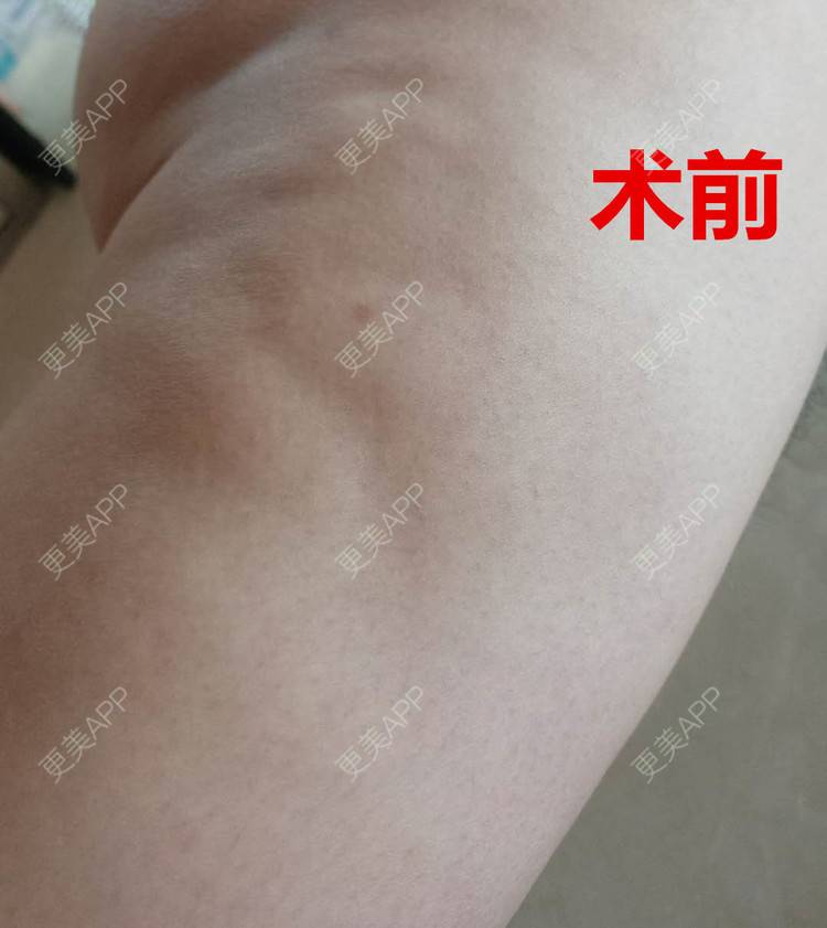 更美 - 更美用户28lcJSvOy1的自体脂肪隆胸经验 | 郑州 | 吸脂瘦大腿 | 自体脂肪隆胸