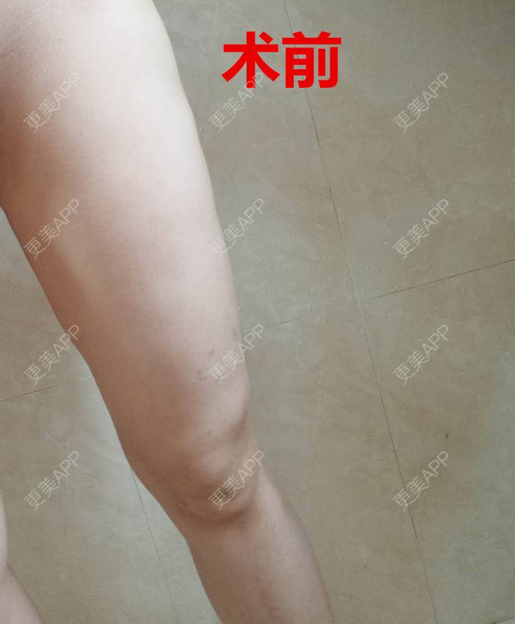 更美 - 更美用户28lcJSvOy1的自体脂肪隆胸经验 | 郑州 | 吸脂瘦大腿 | 自体脂肪隆胸