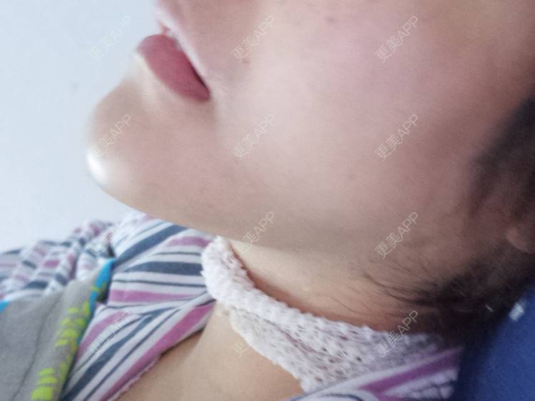 更美 - 更美用户28lcJSvOy1的自体脂肪隆胸经验 | 郑州 | 吸脂瘦大腿 | 自体脂肪隆胸
