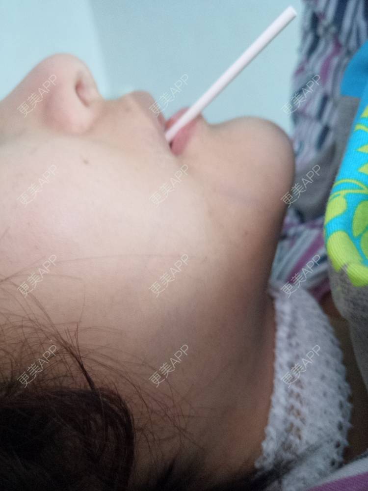 更美 - 更美用户28lcJSvOy1的自体脂肪隆胸经验 | 郑州 | 吸脂瘦大腿 | 自体脂肪隆胸