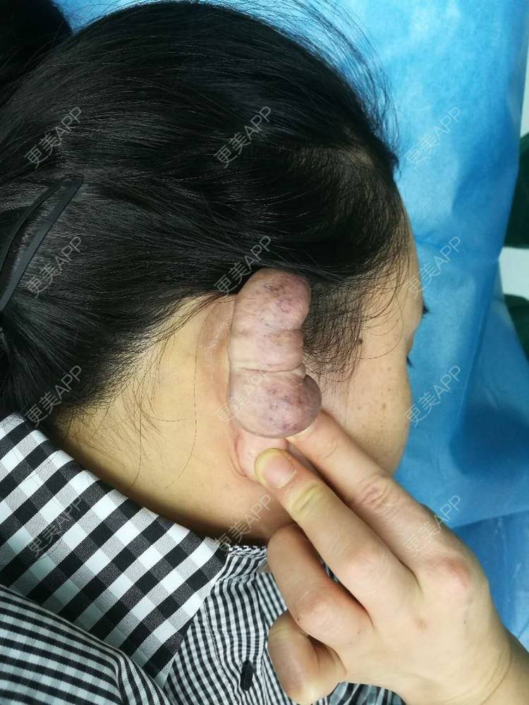 更美 - 疯子也有疯子旳情调林的经验 | 注射淡疤 | 成都