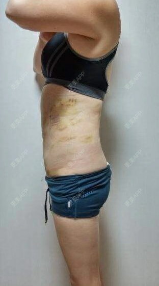 离开地球表面i的腰腹吸脂日记