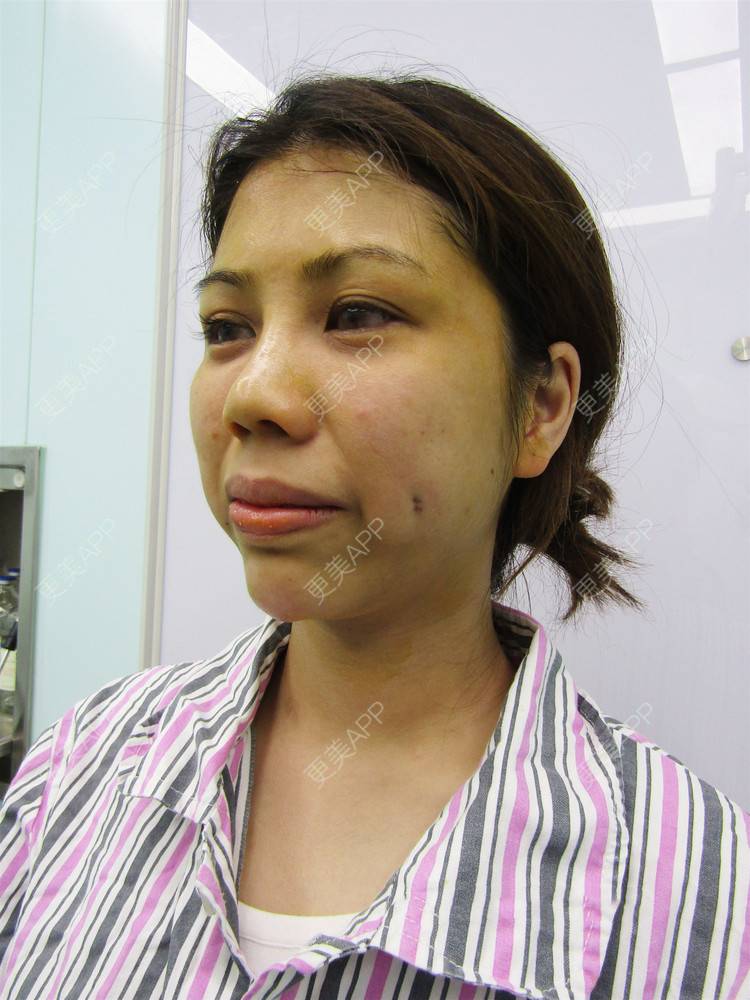 酒窝成形整形_你活的像个疯子刀返翰酒窝成形整形_术后1天__更美